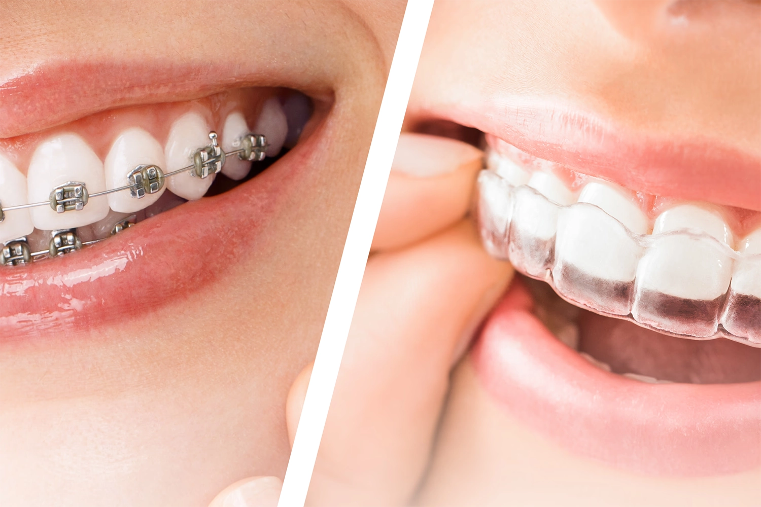 จัดฟันต้องพบทันตแพทย์บ่อยแค่ไหน? แบบเหล็ก vs ใส ต่างกันยังไง