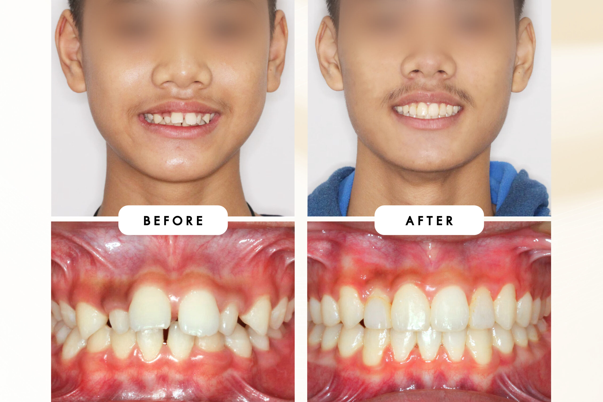 ฟันยื่นคืออะไร? สาเหตุ อาการ และแก้ไขได้ไหม