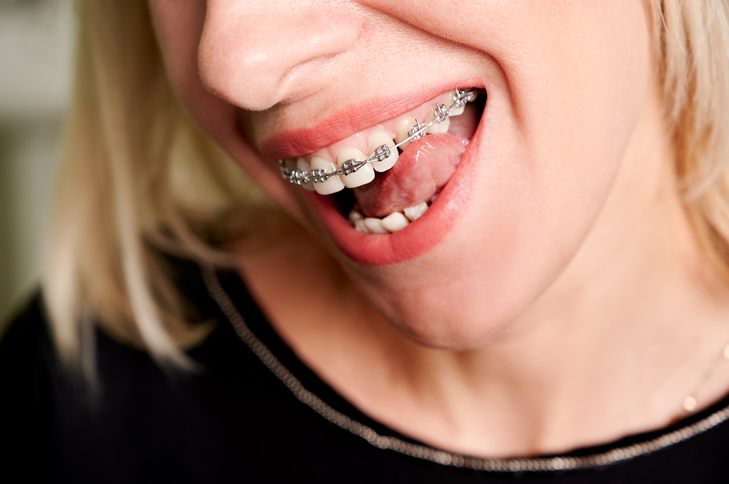 Close up of smiling woman licking white straight teeth with orthodontic brackets. Patient demonstrating results of dental braces treatment. Concept of dentistry, dental care and orthodontic treatment.