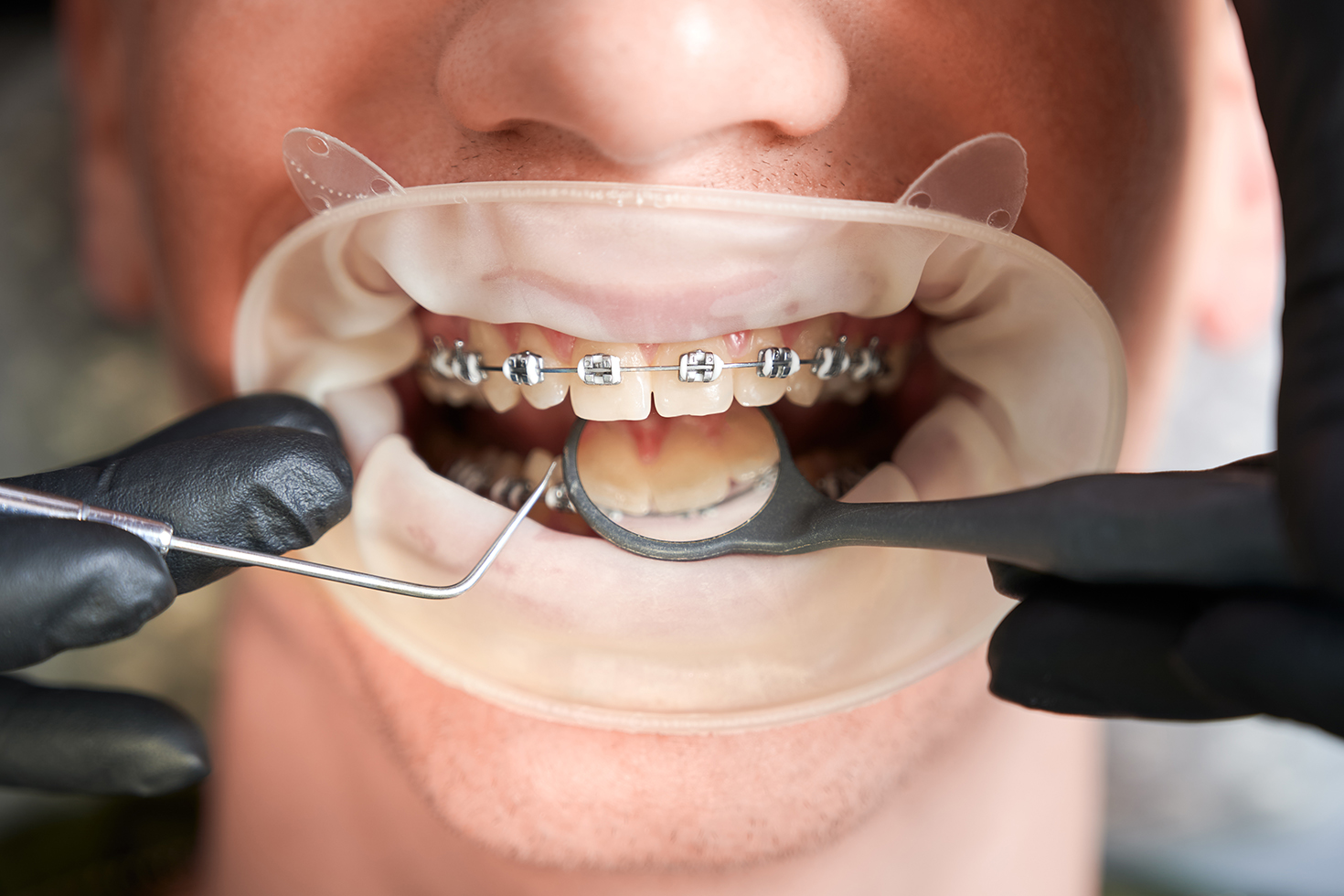 Macro photography of man's mouth with metal braces and cheek retractor. Dentist's hands in rubber gloves making teeth check up with dental tools. Cropped image. Top view. Oral hygiene concept